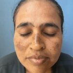 Melasma_Chloasma