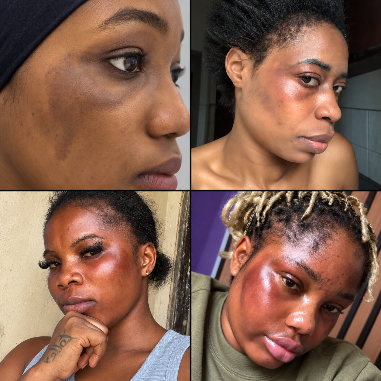 Picha nne za karibu zinazoonesha matatizo mbalimbali ya ngozi ya uso